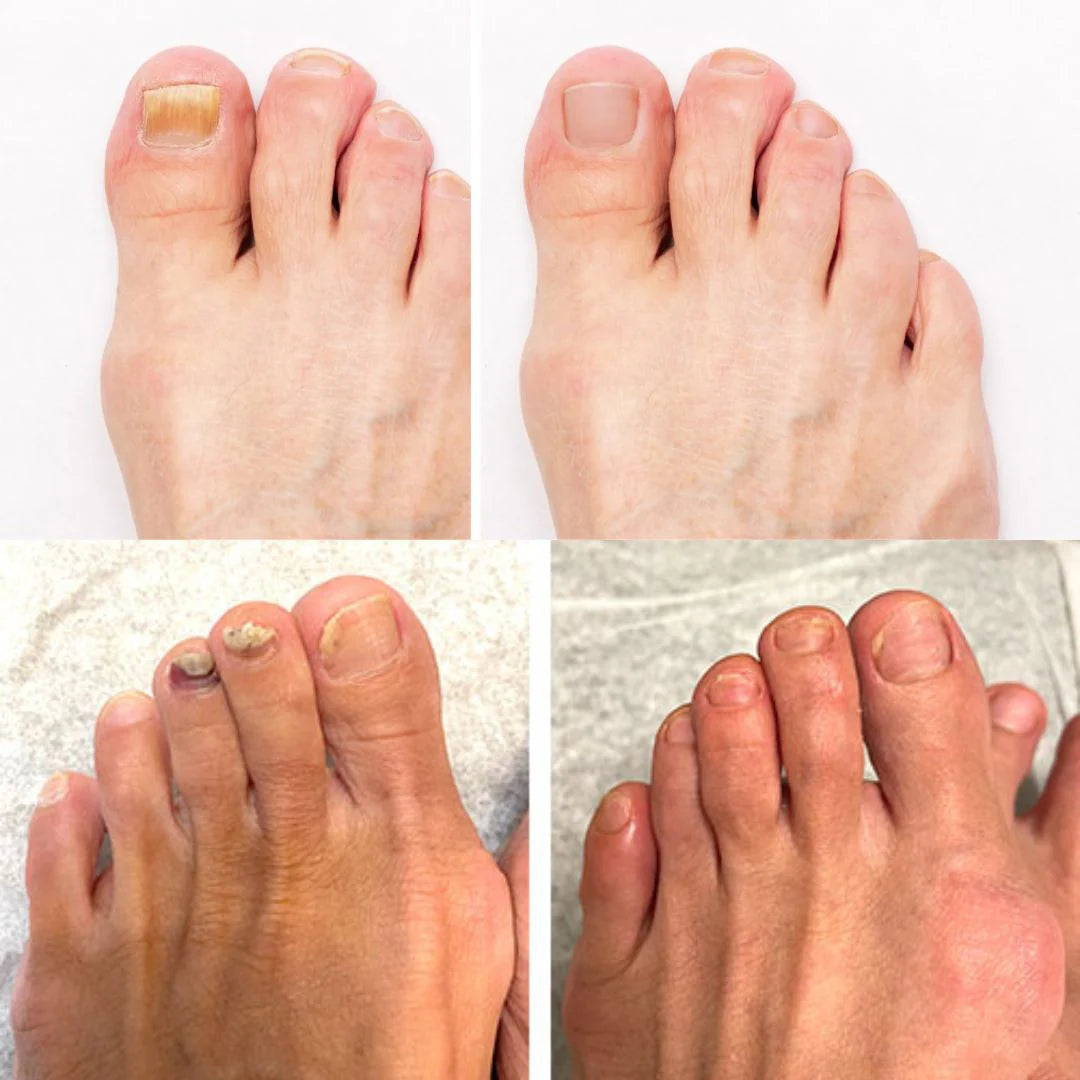 Fußlight® | LLLT-Nagelpilztherapie