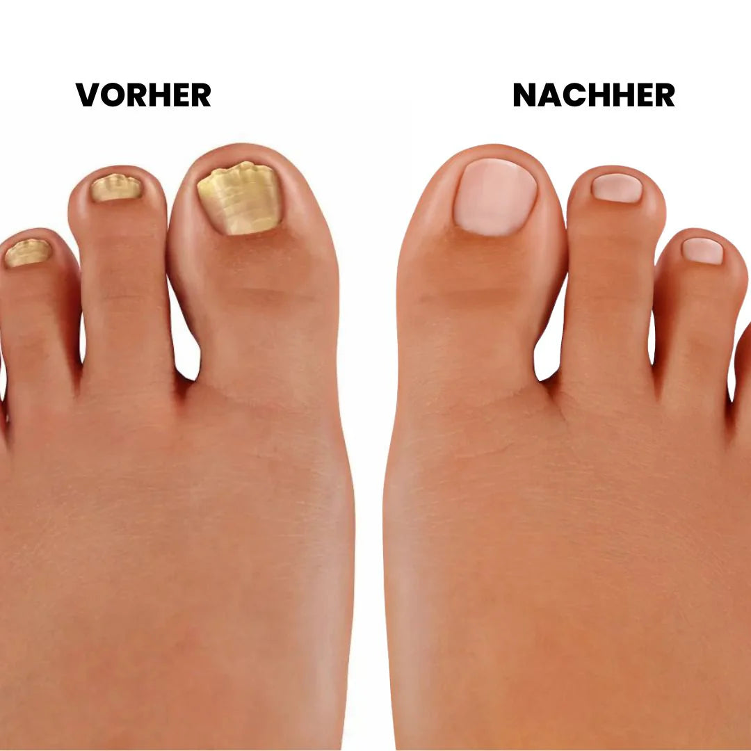 Fußlight® | LLLT-Nagelpilztherapie